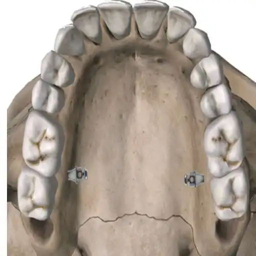 Free play online Mini Implante APK