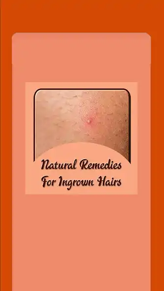 Play Natural Remedies for Ingrown Hair  and enjoy Natural Remedies for Ingrown Hair with UptoPlay