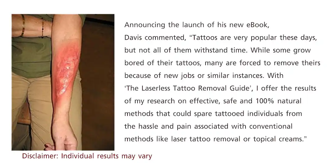 Play Natural Tattoo Removal  and enjoy Natural Tattoo Removal with UptoPlay