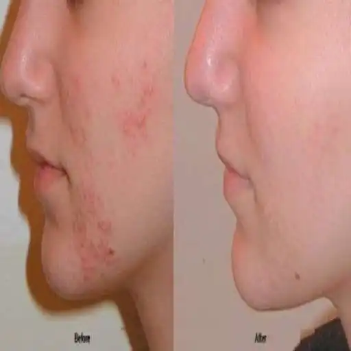 Run free android online Natural Ways to Remove Pimples APK Run free android online Natural Ways to Remove Pimples APK