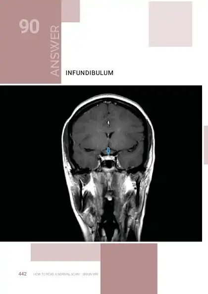 Play Normal Radiology: Brain MRI-1 as an online game online Normal Radiology: Brain MRI-1 with UptoPlay Play Normal Radiology: Brain MRI-1 as an online game Normal Radiology: Brain MRI-1 with UptoPlay