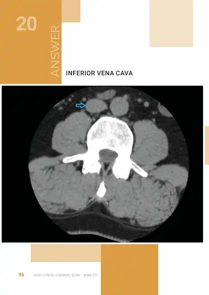 Play Normal Radiology: Spine CT as an online game online Normal Radiology: Spine CT with UptoPlay Play Normal Radiology: Spine CT as an online game Normal Radiology: Spine CT with UptoPlay