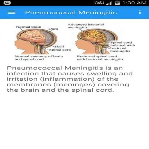 Play Pneumococcal meningitis APK Play Pneumococcal meningitis APK