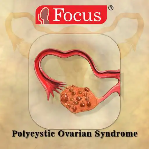 Free play online Polycystic ovarian syndrome APK