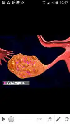 Play Polycystic ovarian syndrome Play Polycystic ovarian syndrome