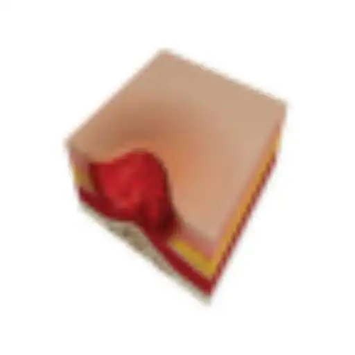 Play Pressure Ulcer APK Play Pressure Ulcer APK