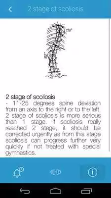 Play Prevent Scoliosis