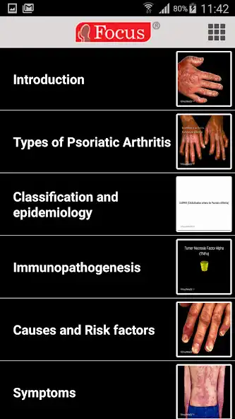Play Psoriatic Arthritis as an online game Psoriatic Arthritis with UptoPlay