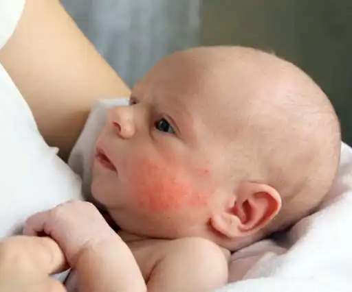 Play Rash in Babies Tips  and enjoy Rash in Babies Tips with UptoPlay