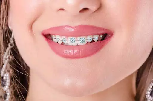 Play APK Real Braces Teeth  and enjoy Real Braces Teeth with UptoPlay com.lab.photo.editor.real.braces.teeth