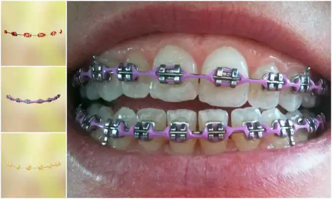 Play Real Teeth Braces Photo Maker