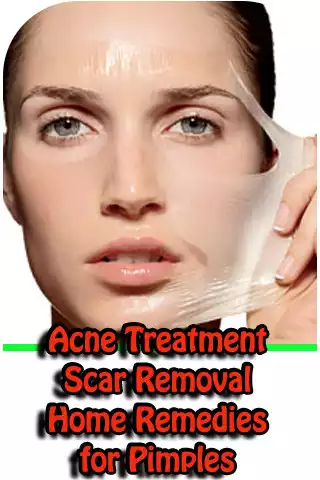 Play Remedies for Pimples, Acne Treatment, Scar Removal