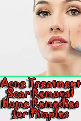 Play Remedies for Pimples, Acne Treatment, Scar Removal