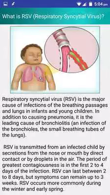 Play Respiratory Syncytial Virus infection RSV in Kids