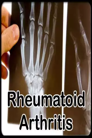 Play Rheumatoid Arthritis Treatment and enjoy Rheumatoid Arthritis Treatment with UptoPlay Play Rheumatoid Arthritis Treatment and enjoy Rheumatoid Arthritis Treatment with UptoPlay