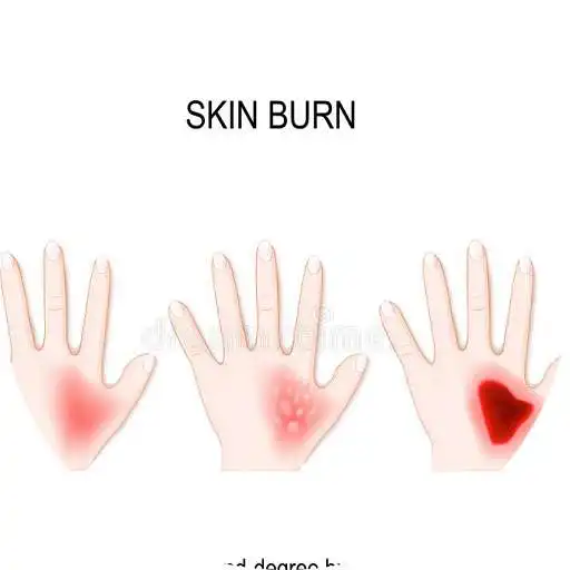 Play Skin Burns APK