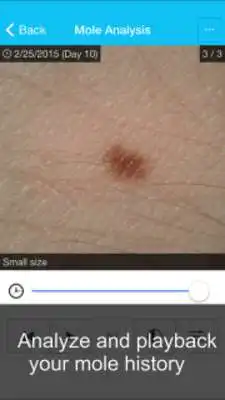 Play Skin Cancer App - MySkinPal