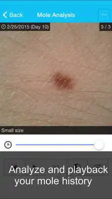 Play Skin Cancer App - MySkinPal