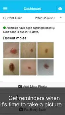 Play Skin Cancer App - MySkinPal