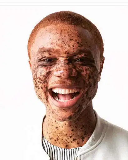 Play Skin Cancer  and enjoy Skin Cancer with UptoPlay Play Skin Cancer  and enjoy Skin Cancer with UptoPlay