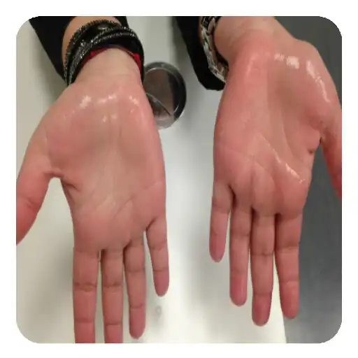 Play Sweaty Palms and Feet (Guide) APK