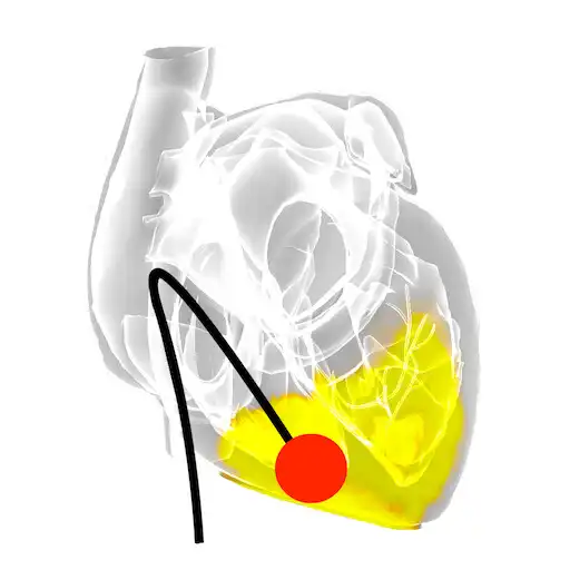 Play Temporary Cardiac Pacing APK Play Temporary Cardiac Pacing APK