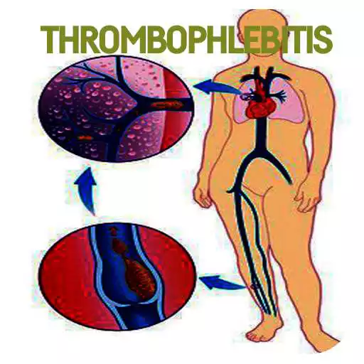 Free play online Thrombophlebitis Disease APK