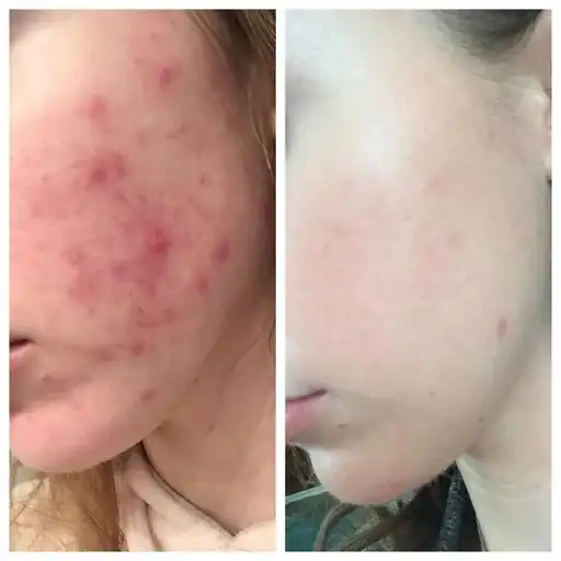 Play Treat acne naturally at home APK