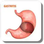 Free play online Treat Gastritis APK
