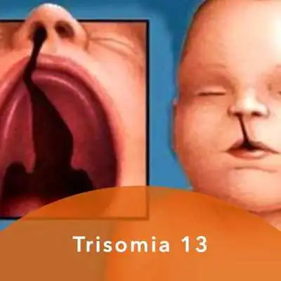 Play Trisomia 13 Play Trisomia 13