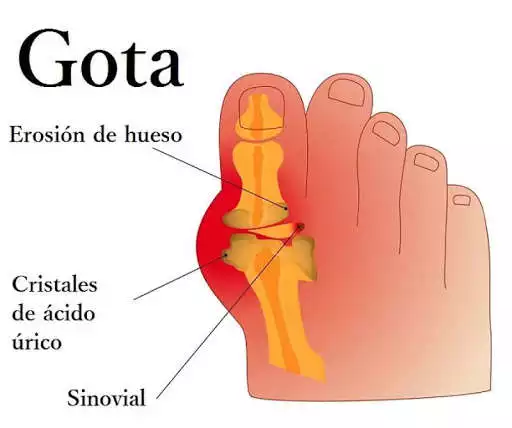 Play Uric acid tips as an online game Uric acid tips with UptoPlay