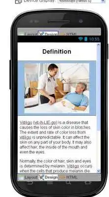 Play Vitiligo Disease Symptoms Play Vitiligo Disease Symptoms