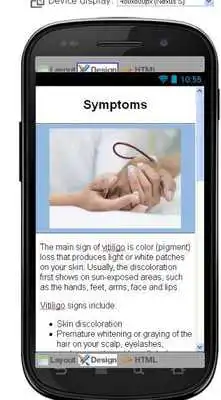 Play Vitiligo Disease Symptoms Play Vitiligo Disease Symptoms
