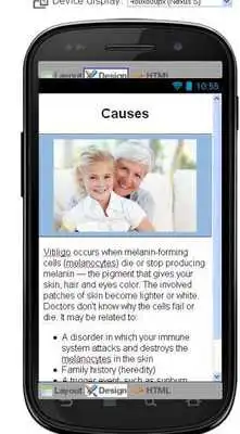 Play Vitiligo Disease Symptoms Play Vitiligo Disease Symptoms
